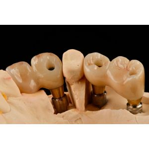 Self Tapping 3.0mm Thread Dental Titanium Implant Optimized Functionality