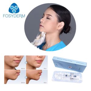 Fosyderm Hyafilia 2ml Lip Filler Hyaluronic Acid Gel Injection