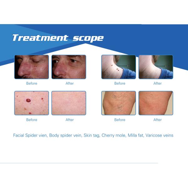 Best Effective and Immediate Result 980nm diode laser spider vein laser vascular removal