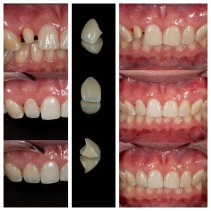 Zirconia Dental Crowns Fabrication Lab | Precision Crown Outsourcing - Joydentalab
