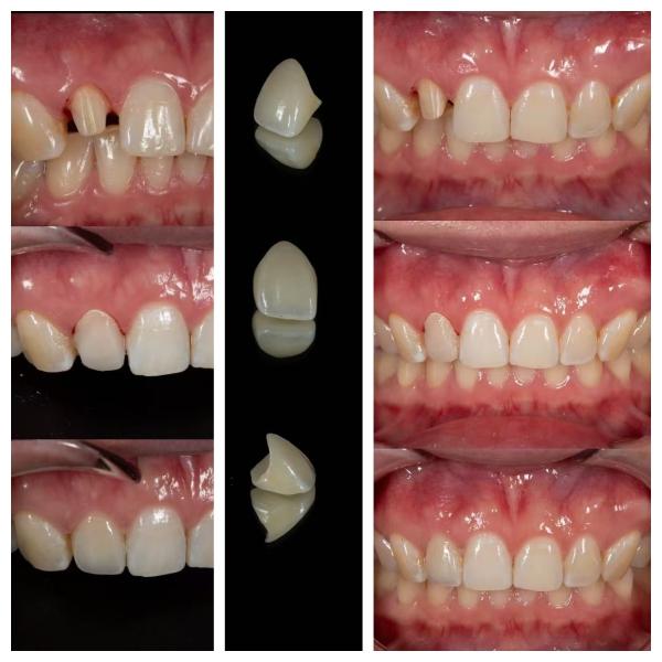 Quality Zirconia Dental Crowns Fabrication Lab | Precision Crown Outsourcing - Joydentalab wholesale