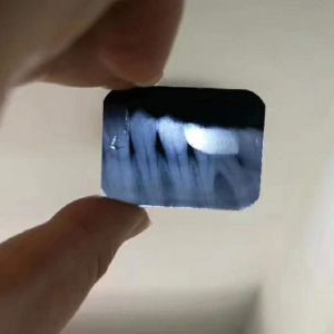 Imaging Handheld Digital Teeth X Ray Machine Wireless Medical Equipment