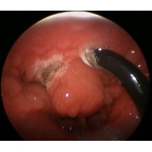 4.4mm Diameter PLA402 Tonsilectomy Wand For Medical Surgery