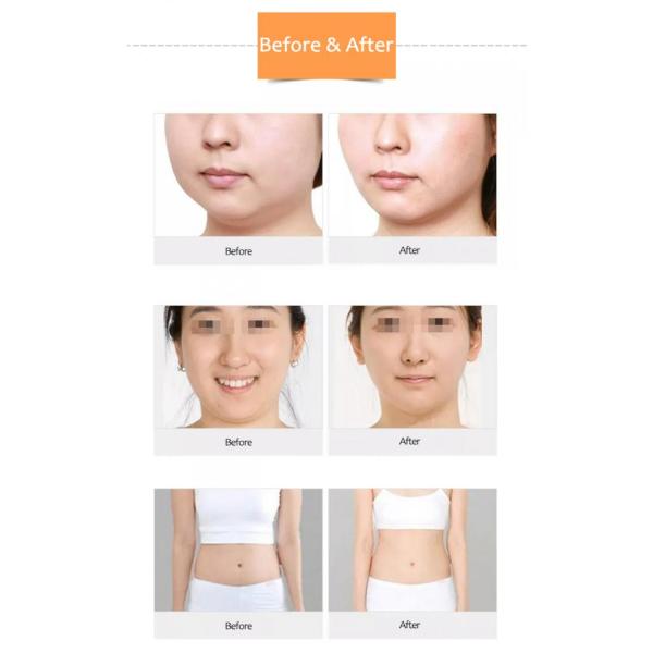 Radio Frequency Skin Tightening Machine For Skin Laxity Treatment Beauty Salon Machine 4