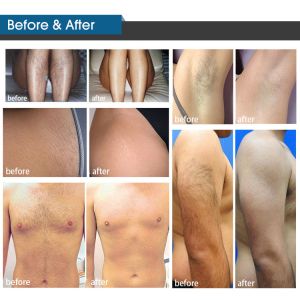 Vertical Big Spot Size YAG IPL Diode Laser Device 808nm Diode Beauty Equipment