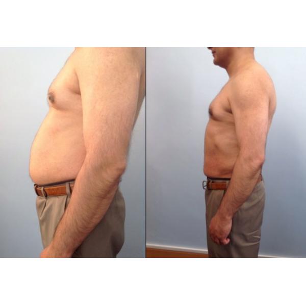 hifu machine hifushape fat reduce shaping best ultrasound slimming machine