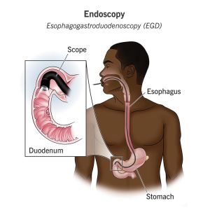 Medical Endoscope，An endoscopy is a procedure done to examine structures inside