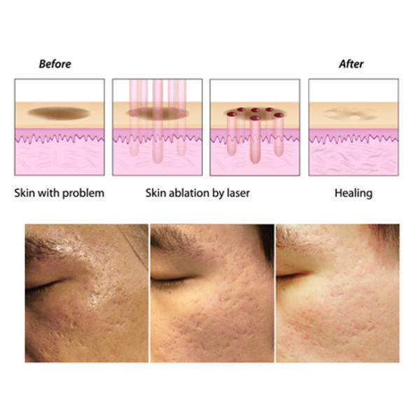 3 In 1 System CO2 Laser Beauty Equipment For For Acne Scars Removal Safe