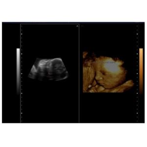 4D Function Optional Laptop Hand Held Doppler Machine With Transducer 2~12MHz