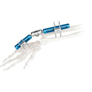 Orthopedic Surgical External Fixation Device Wrist