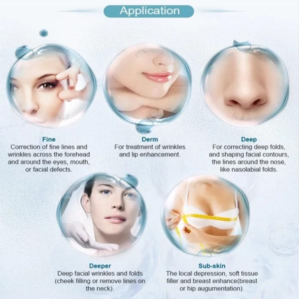 Lip Juvederm 2ml Dermal Filler Hyaluronic Acid Injections
