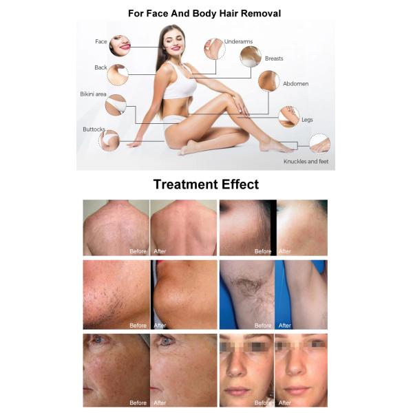 Direct Factory Supplier Lazer Hair Removal Machine Portable For Beauty Center Laser Hair Removal And Skin Rejuvenation