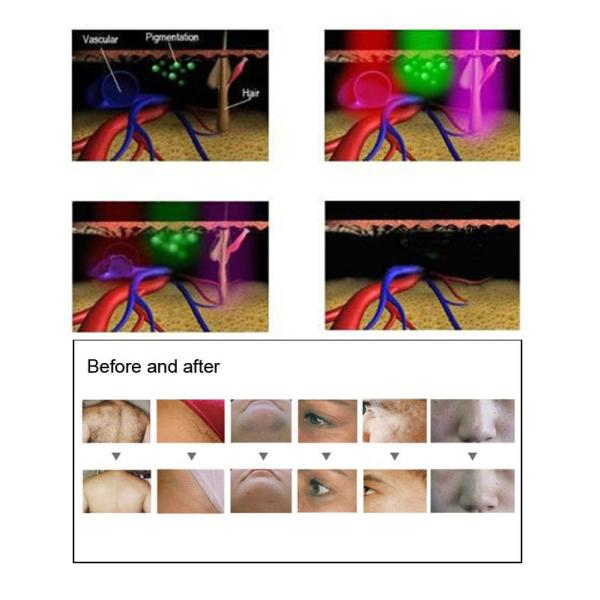 480nm 530nm DPL Laser Hair Removal RF Laser Resurfacing Machine