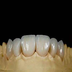 High Translucency Emax Porcelain Veneers Crown with Better Materials by Ivoclar