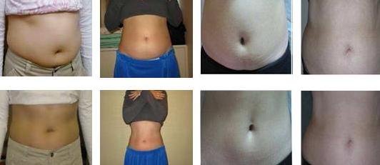 Nubway best selling machine -Cryolipolysis Slimming Machine ,combining Cryolipolysis,Cavitaiton and RF 3 technologies