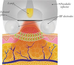 Professional Non Invasive Liposuction Machine For Vacuum Weight Loss / Body Slim