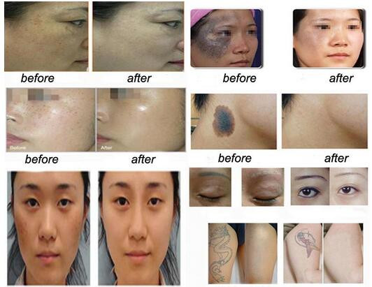 Picosecond q switched nd yag laser picosure q-switched tattoo removal laser machine