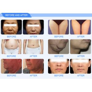 HIFU Technology Wrinkle Removal Machine For Lifting Tightening Skin