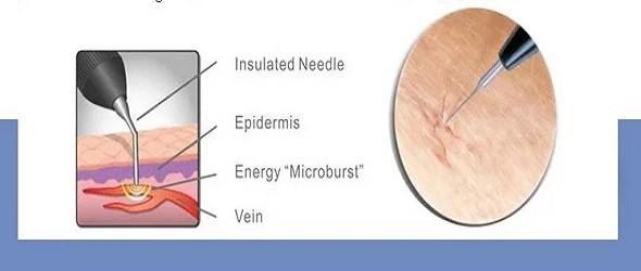 35w Spider Vein Removal High Frequency Rf Facial Machine