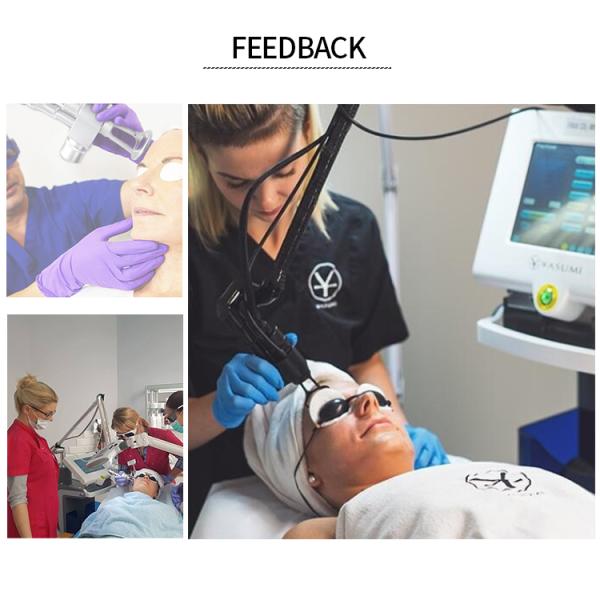 CO2 Fractional Laser Machine Most Effective Solution For Scar Removal