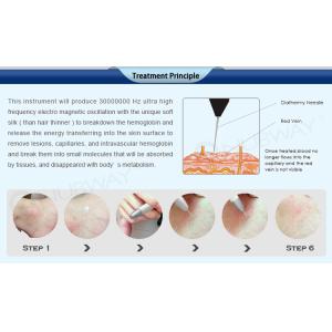 Immediately result Spider Vein Removal Machine With 30.56MHz High Frequency
