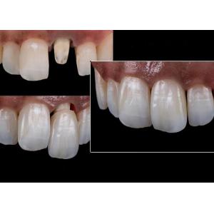 All Ceramic Crowns and Bridges Designed for Superior Aesthetics Durability and