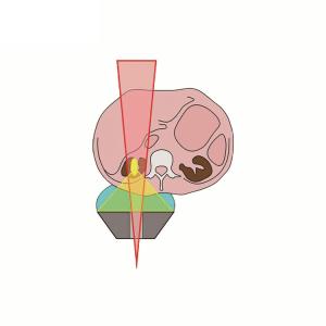 Electromagnetic Extracorporeal Shock Wave Pneumatic Lithotripter
