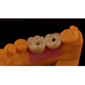 Porcelain Zirconia Cement Retained Screw Implant Hexagonal Head Shape for Custom