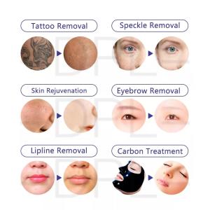 Custom Portable Q Switched Nd Yag Laser Qswitch Tattoo Removal And Carbon Peel