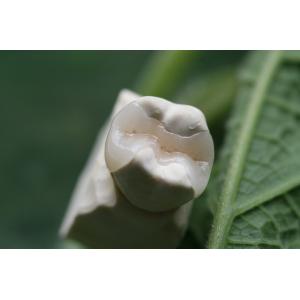 Fixed Prosthetics Permanent Solution EMAX Dental Crown