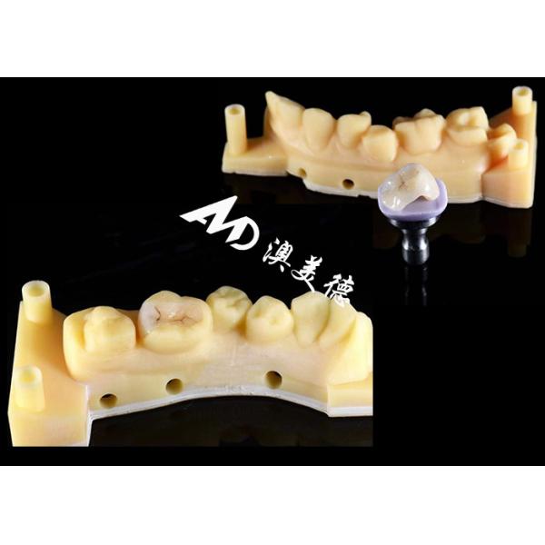 Smooth Hypoallergenic Ceramic Inlays Onlays Custom Fit Stain Resistance High