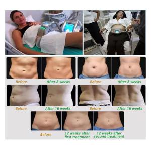 7 Handles 40khz Cavitation Multipolar Rf Ultrasonic Body Slimming Machine