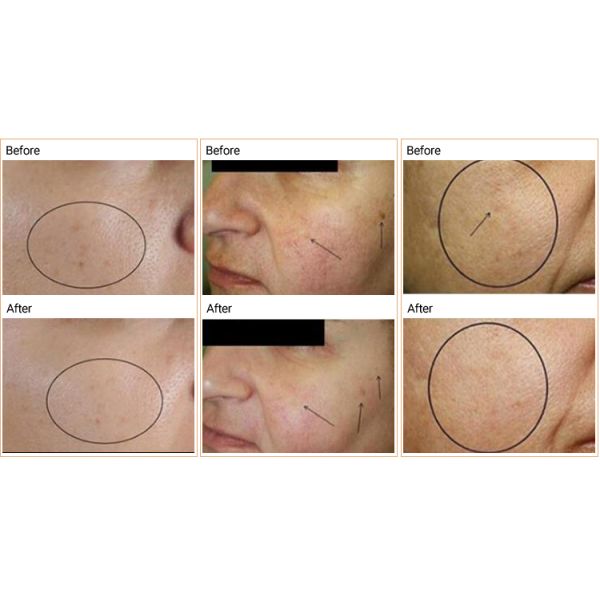 3 Color Light Therapy Facial Machines Wrinkle Removal For Beauty SPA Non - Invasive