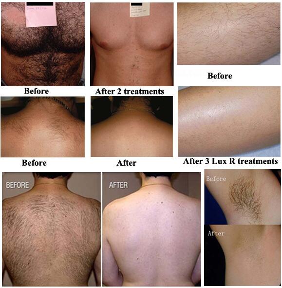 2016 Hot sale fast opt shr wrinkle removal hair removal and skin rejuvenation IPL beauty equipment