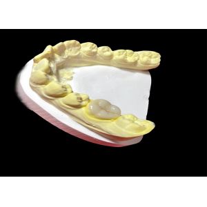 China High-Quality Ceramic Inlays and Onlays for Seamless and Long-Lasting Tooth Restoration on sale