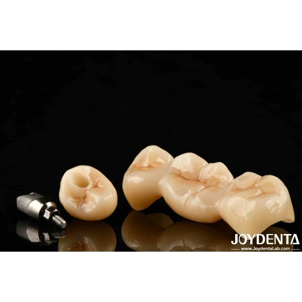 Multilayer Full Zirconia High Resistance To Cracking And Durability For Long