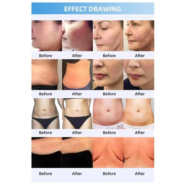 Fat Freezing Cryotherapy Machine Thermal Shock Slimming Body Sculpting Beauty System