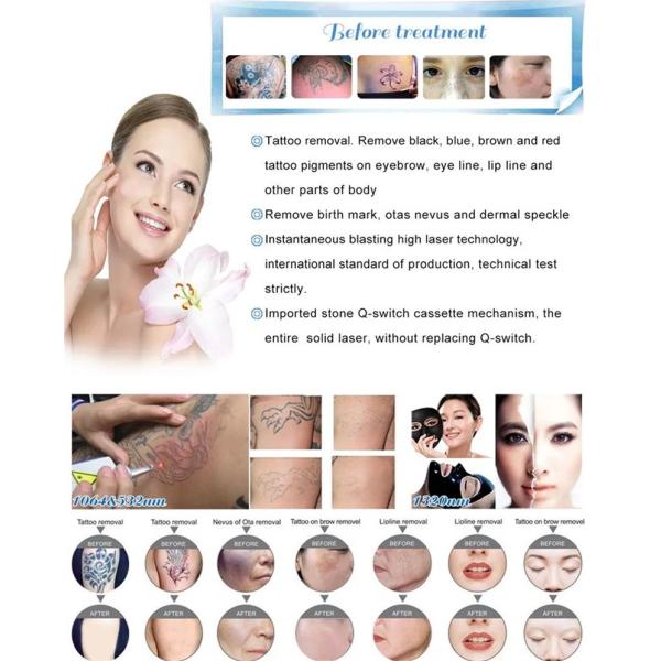 Vertical Tattoo Removal Pico Laser Machine Q Switched Nd Yag