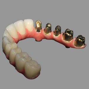Class 2 Hybrid Malong Full Arch AOX Implant Bridge Titanium Bar with Full Solid