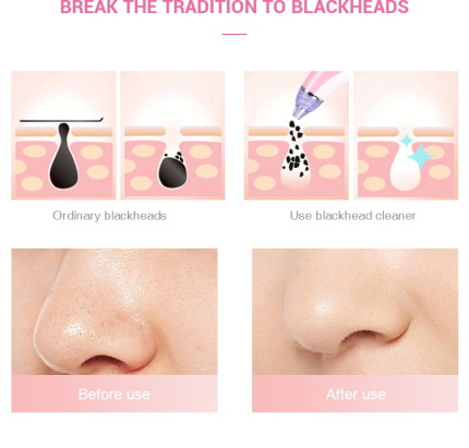 Vacuum Suction Remover Blackhead Extraction Machine Washing Skin Exfoliating