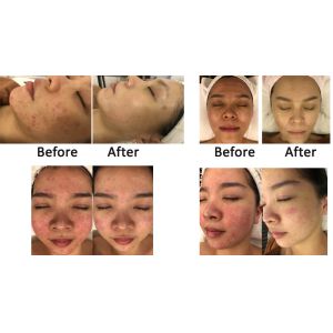 500W Mesotherapy Needle Free Machine Anti Aging Skin Whitening Machine