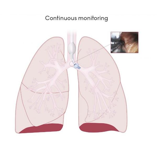 Disposable Medica Visual Double Lumen Et Endotracheal Tube With Camera Elastic Material 1