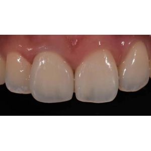 High Biocompatibility PFM Crown Porcelain Fused For Back Teeth Restoration