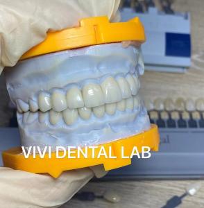 China High Esthetic Teeth Emax Laminate Veneers Incisal Translucency China Dental Lab on sale