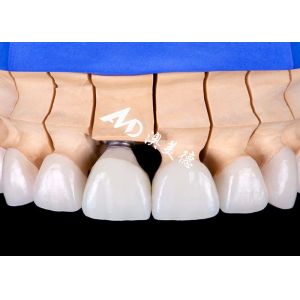 China Functional Aesthetic Dental Implant Crown Bridge – Precision and Durability on sale