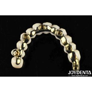 Comfortable To Wear Ti-Bar Zirconia Hybrid Bridge Restores Chewing Function