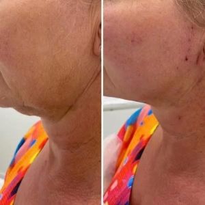 Wholesale 1470nm Lipolysis Lipo Laser Device Endolaser Liposuction Machine