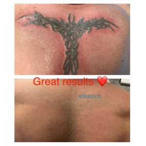 2000W Q Switched Nd Yag Laser Tattoo Removal Machine 50kg With LCD Touch Screen