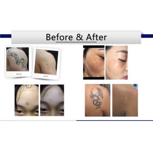 Nd Yag Pico Laser Tattoo Removal , Laser Resurfacing Machines 1064nm