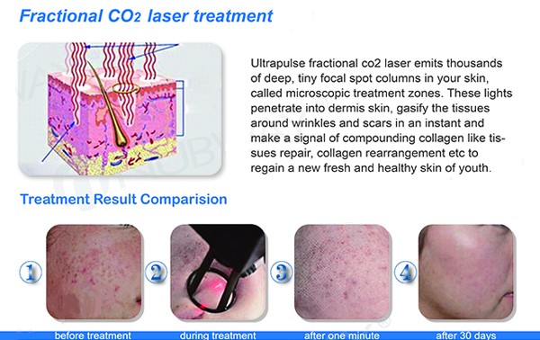 Multifunction medical laser co2 fractional / fractional co2 laser/co2 fractional laser CE/FDA approval